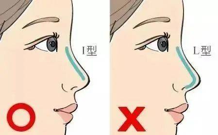 鼻部综合整形效果好不好(什么样的鼻子适合接受手术)