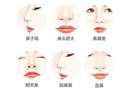 鼻综合整形有哪些项目(硅胶假体隆鼻的优缺点)