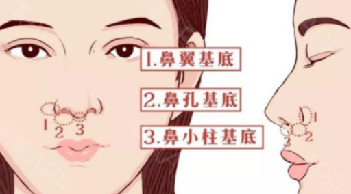 鼻部综合的整形项目(鼻综合与假体隆鼻有什么区别)