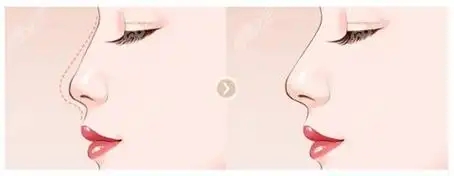 什么是鼻部综合整形术(鼻部综合手术好处在哪里)