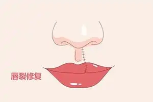 唇裂修复效果怎么样(早期进行唇腭裂修复的好处有哪些)