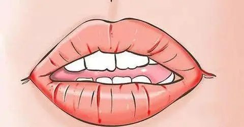 唇裂修复什么时候做(如何预防婴儿唇裂发生的概率)