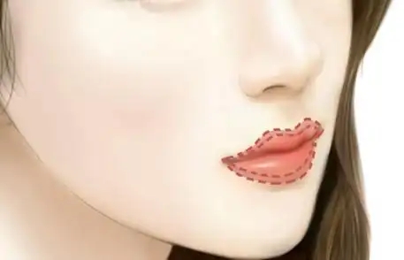 发生唇腭裂后要如何治疗呢(修复患儿唇裂的时间是什么时候)