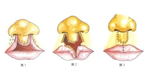 唇裂修复有哪些优势(比较常见的唇腭裂修复的时间选择)