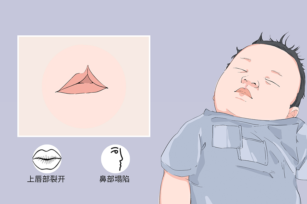 唇裂修复有哪些优势(唇腭裂能完全修复正常吗)