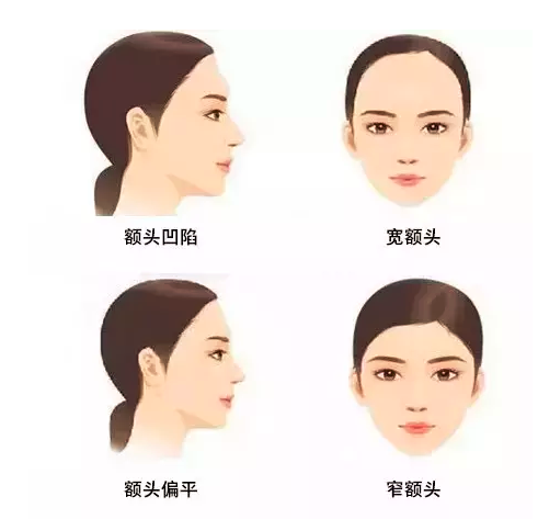 为什么需要丰额头(自体脂肪丰额头需几次)