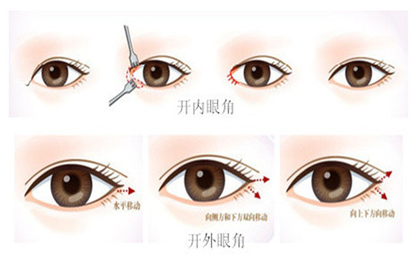 开眼角术前要注意哪些问题(开眼角效果持久吗)