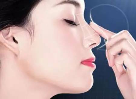 膨体隆鼻会出现移位吗(膨体隆鼻和硅胶隆鼻有什么区别吗)