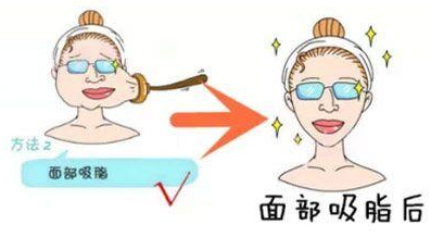做完面部吸脂的效果明显吗(面部吸脂术后会反弹吗)