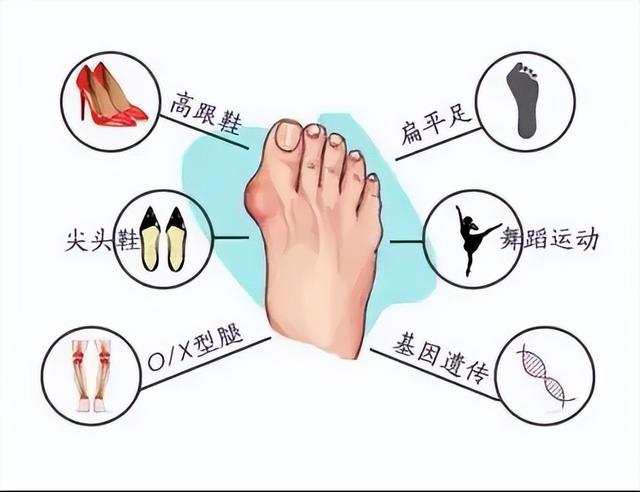 微创拇外翻矫正优势(威海大脚骨矫正术前准备)