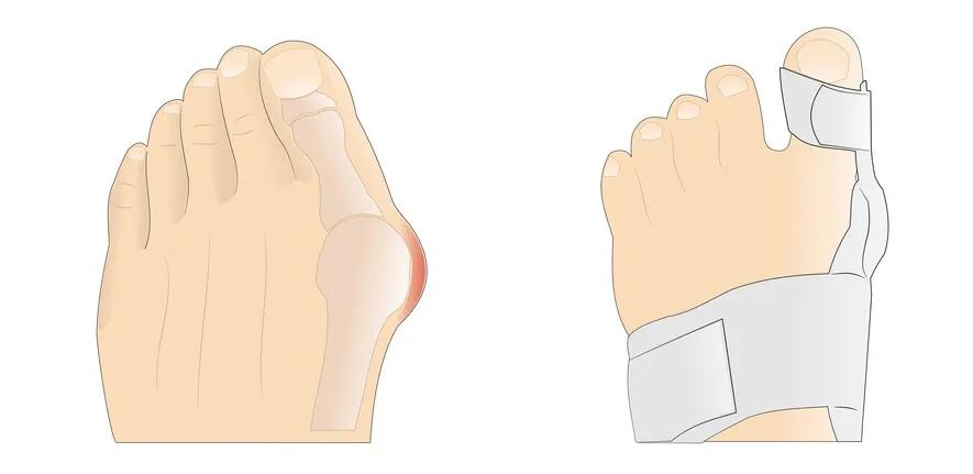 什么方法矫正大脚骨效果最佳(大脚骨矫正原则)
