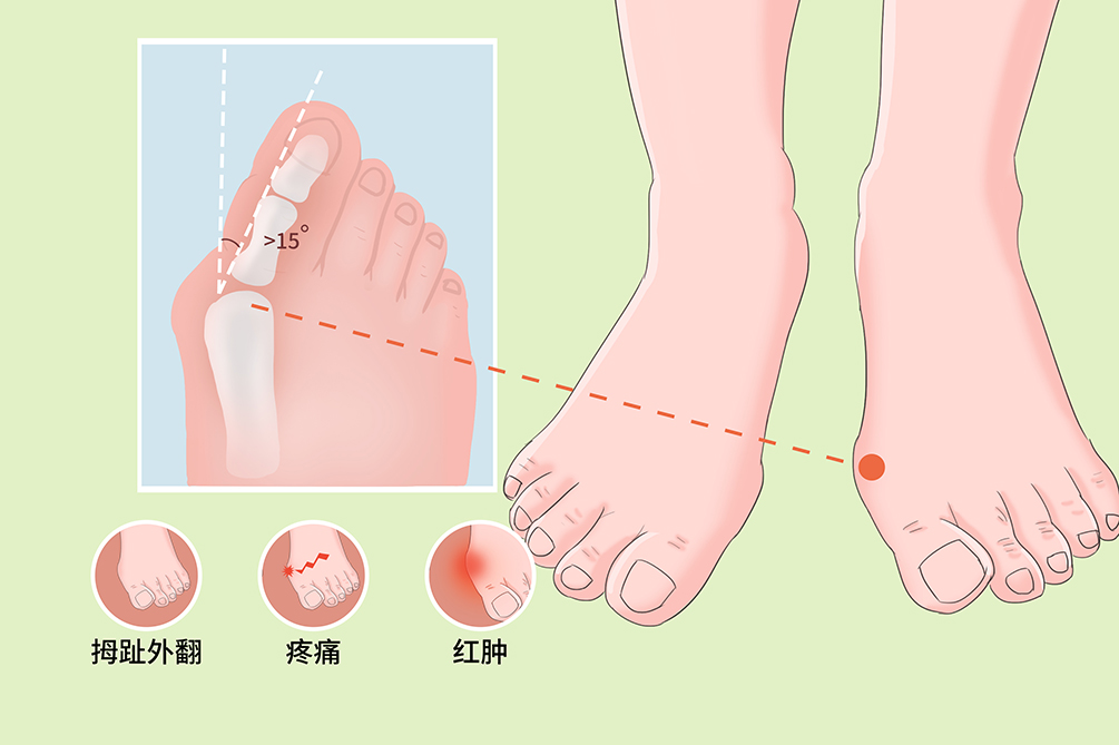 微创拇外翻矫正优势(南阳拇外翻矫正术后护理)
