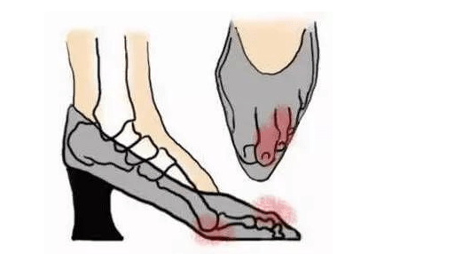 福州拇外翻矫正术的手术方式(不同轻重程度的脚外翻要怎么矫正)