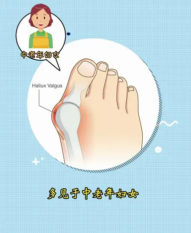 威海大脚骨矫正术前准备(微创大脚骨矫正术优点)