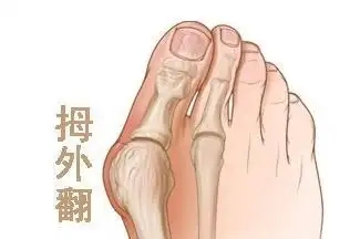 大脚骨矫正不一定要动手术(治疗拇外翻有手术疗法和非手术疗法)