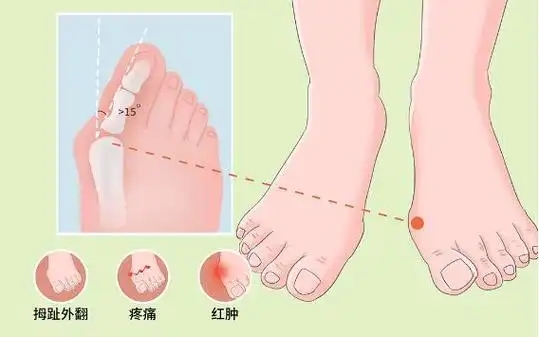 微创大脚骨矫正术后完全好要几天(大脚骨矫正手术效果) 微创大脚骨矫正术后完全好要几天(大脚骨矫正手术效果)