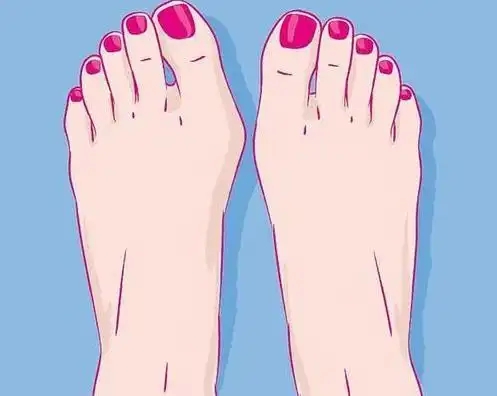 拇外翻会遗传么(大脚骨矫正术后不会感染)