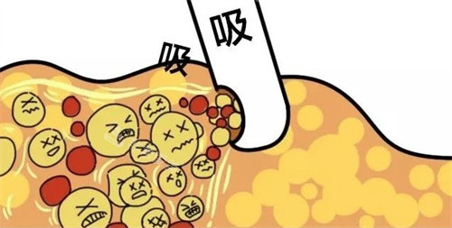 全身吸脂术前需要做好哪些注意事项(全身吸脂术后要注意什么)