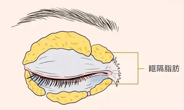 激光去眼袋让眼部皮肤光滑又平整(术后眼袋复发跟这些方面有关系)
