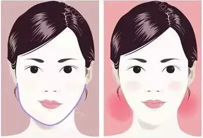 上海咬肌切除手术多久能看到效果(广州去咬肌手术恢复期是多久)