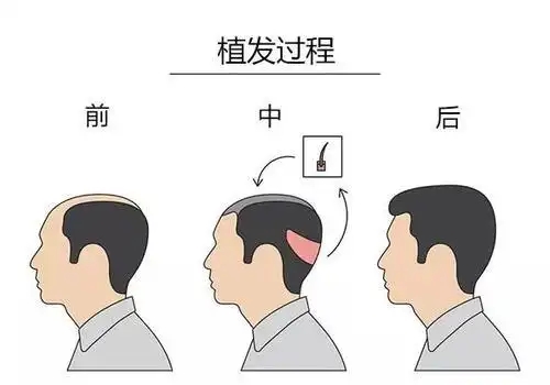 头发种植后两周内避免进行剧烈的运动吗(头发加密是多少钱)