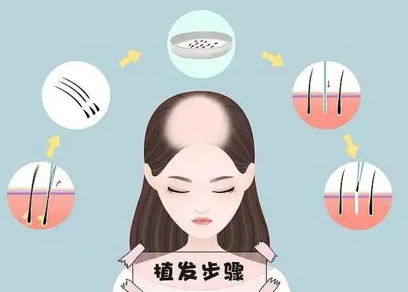 疤痕植发效果好吗(头发种植的效果)