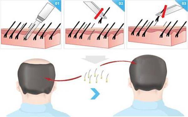 头发种植手术后的扎发时机你了解吗(植发失败修复的注意事项)