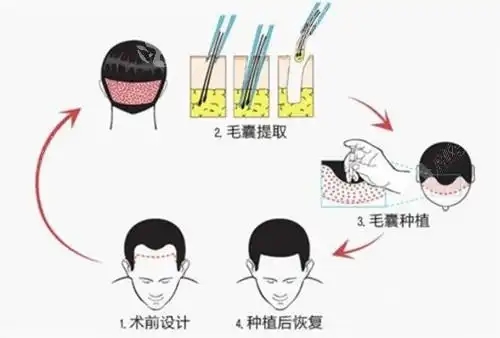 头发加密需开刀吗(头发移植后可以上班吗需要休息几天)