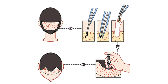 头发种植效果真实吗(头发种植术后如何护理)