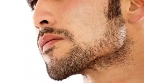 络腮胡脱毛术前术后注意事项主要有什么(冰点脱络腮胡的效果如何)