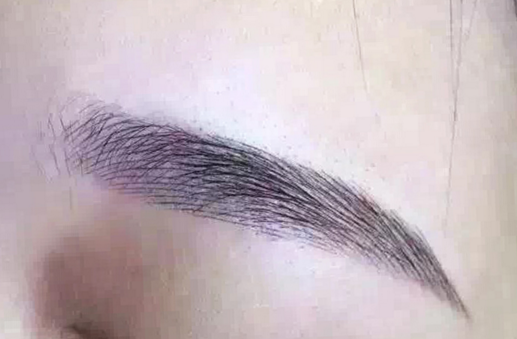 提眉术后注意事项(提眉手术消肿持续多长时间)