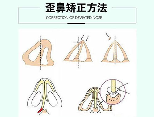歪鼻矫正要多少钱(歪鼻矫正的注意事项)