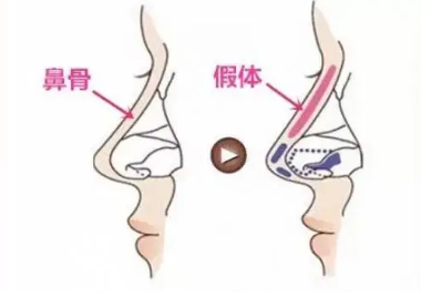 歪鼻矫正术前注意事项(歪鼻矫正手术方法是什么)