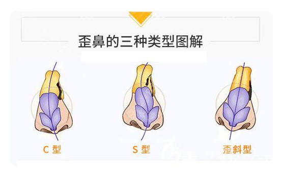 珠海做歪鼻矫正手术需要什么设备吗(歪鼻矫正术前注意事项)