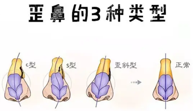 歪鼻矫正手术方法有哪些呢(歪鼻矫正术后如何处理)