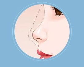 歪鼻矫正术后多久恢复(歪鼻矫正费用的影响因素)