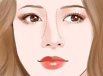 歪鼻整形术后注意什么事项(歪鼻矫正费用的影响因素)