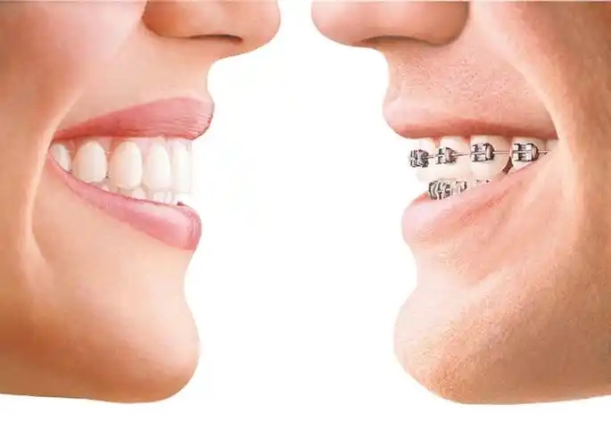 牙齿矫正反弹了怎么办(牙齿矫正价格有什么有关)
