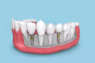 种植牙安全吗(种植牙的寿命多长) 种植牙安全吗(种植牙的寿命多长)