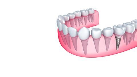种植牙会不会掉呢(即拔即种和拔牙三个月后种哪个好) 种植牙会不会掉呢(即拔即种和拔牙三个月后种哪个好)