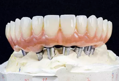 种植牙的过程有哪些(种植牙会出现脱落的现象吗) 种植牙的过程有哪些(种植牙会出现脱落的现象吗)